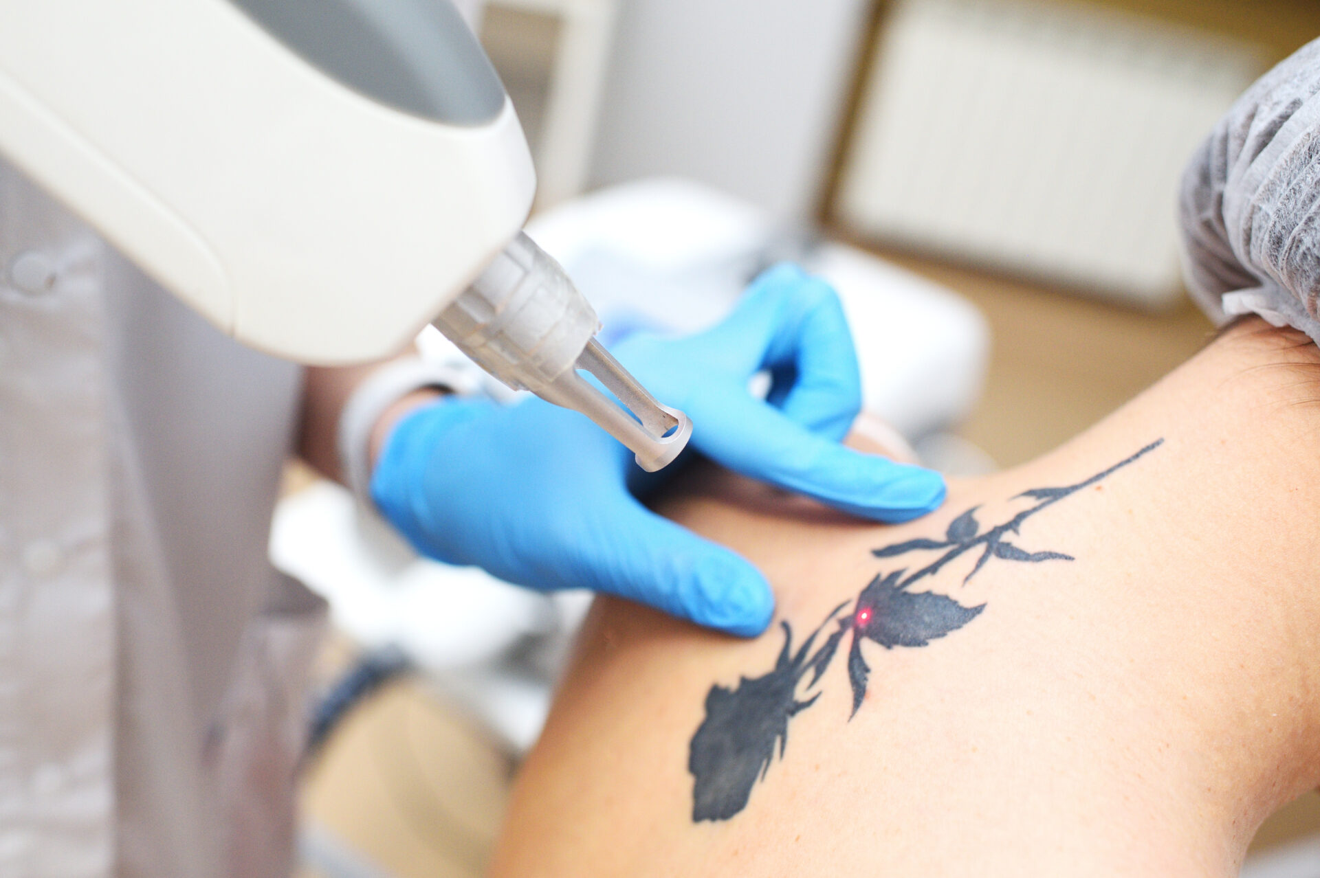 cosmetologist removes the tattoo to the patient us 2026 01 06 10 12 55 utc